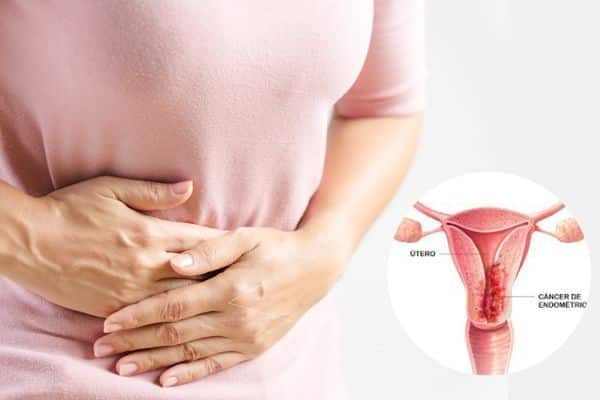 Cirurgia para Câncer de Útero Endométrio